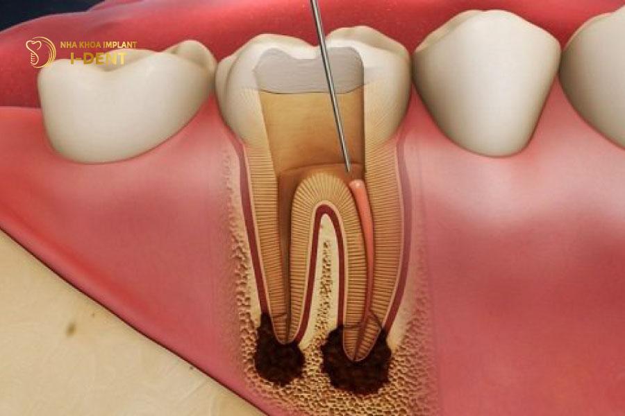 Viêm tủy răng do bọc sứ sai kỹ thuật